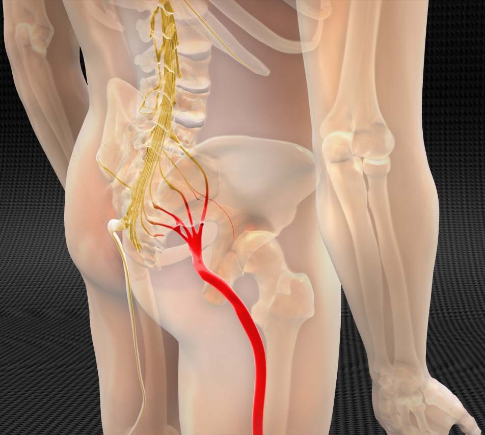 Wellness EMS relieve sciatica